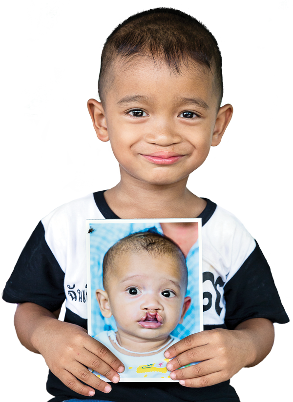 Akekaphob Khumloy Smiling after his surgery