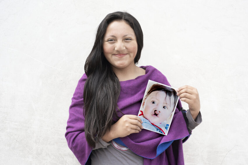 Teenage girl holding photo of her younger self before she received cleft surgery.