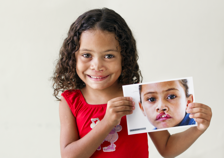 5-year-old female patient shows off her new smile after receiving cleft surgery in Fortaleza, Brazil.