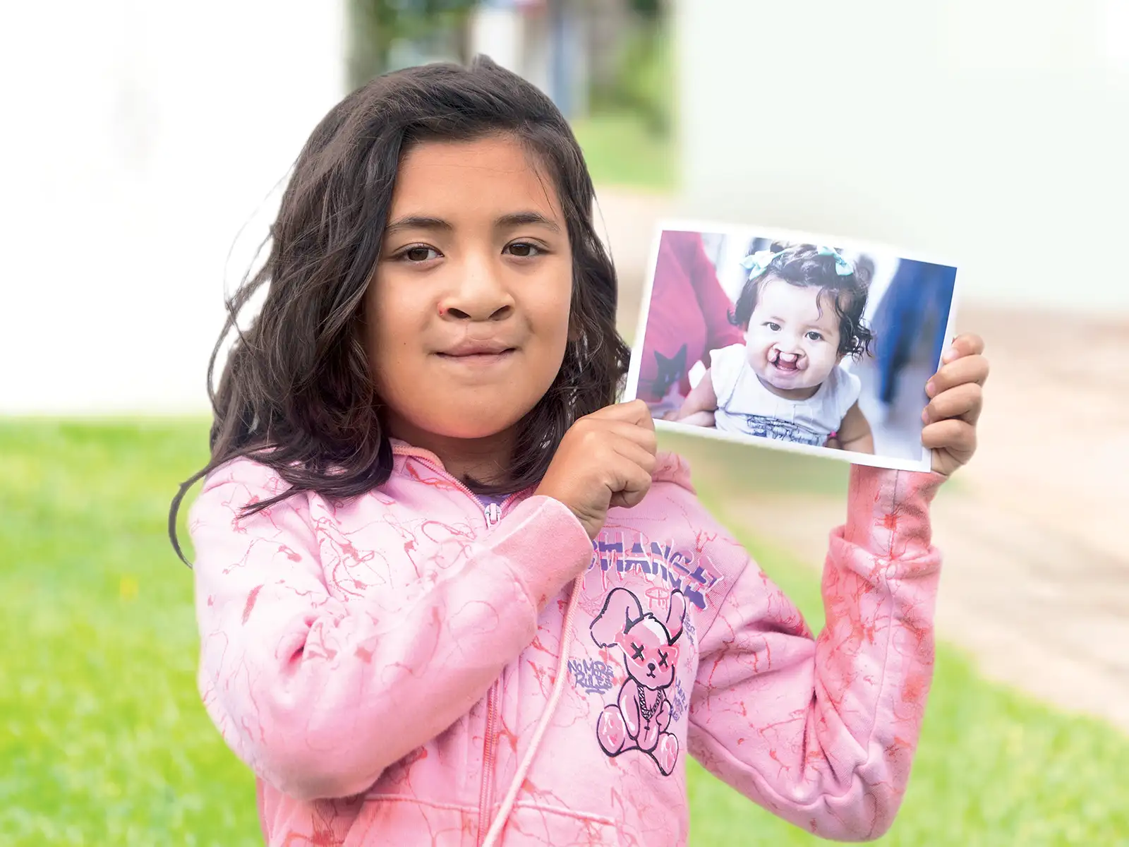 Brenda from Paraguay After Surgery Brenda from Paraguay After Surgery
