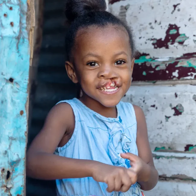 Daniella, age 4, from Dominican Republic, before surgery