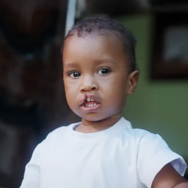 Christopher from Dominican Republic before his surgery