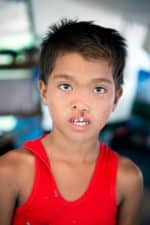 Efren Mahinay Before Surgery