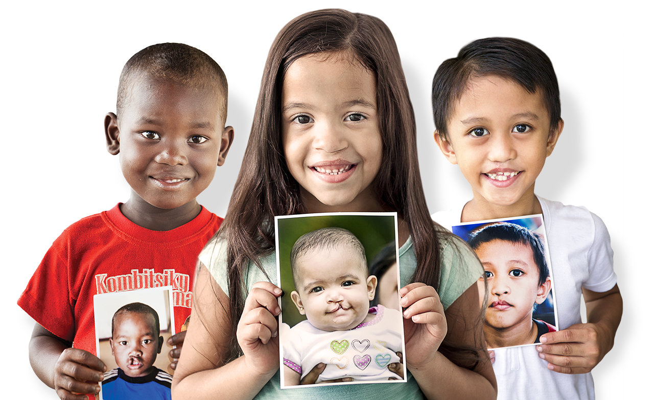 Three children holding their before cleft surgery photos Three children holding their before cleft surgery photos