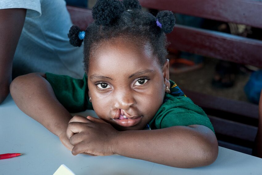 Ramata before her surgery, Ghana 2015