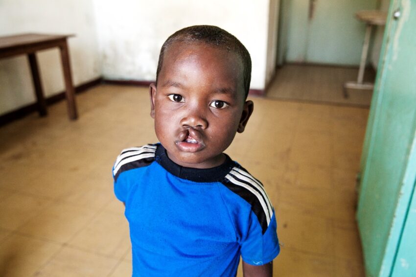 A young boy with a cleft lip looks into the camera