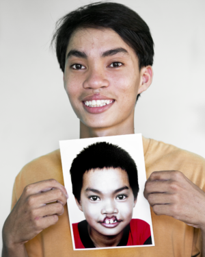 17 year old male holds a photo of his younger self before receiving cleft surgery